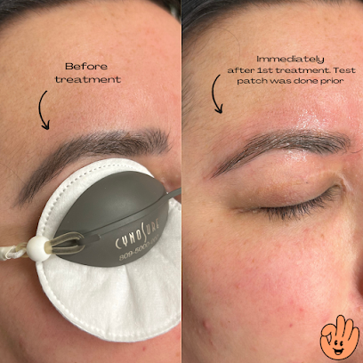 Swift Tattoo Removal